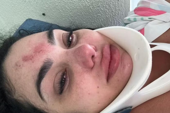 “Milagre ter sobrevivido”, diz mulher que teve o cabelo preso em sugador de piscina e cervical quebrada em Capão da Canoa